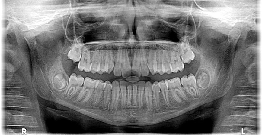 xray x-ray, x-ray, photo, roentgen, teeth, jaw, dentist, orthodontist, occlusion, braces, jaws, tooth, the doctor, molar, x-ray, x-ray, x-ray, roentgen, teeth, dentist, dentist, dentist, dentist, dentist, orthodontist, orthodontist, tooth, tooth, molar