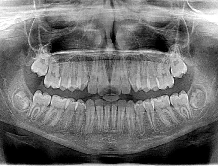 xray x-ray, x-ray, photo, roentgen, teeth, jaw, dentist, orthodontist, occlusion, braces, jaws, tooth, the doctor, molar, x-ray, x-ray, x-ray, roentgen, teeth, dentist, dentist, dentist, dentist, dentist, orthodontist, orthodontist, tooth, tooth, molar