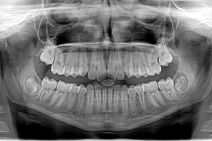 xray x-ray, x-ray, photo, roentgen, teeth, jaw, dentist, orthodontist, occlusion, braces, jaws, tooth, the doctor, molar, x-ray, x-ray, x-ray, roentgen, teeth, dentist, dentist, dentist, dentist, dentist, orthodontist, orthodontist, tooth, tooth, molar