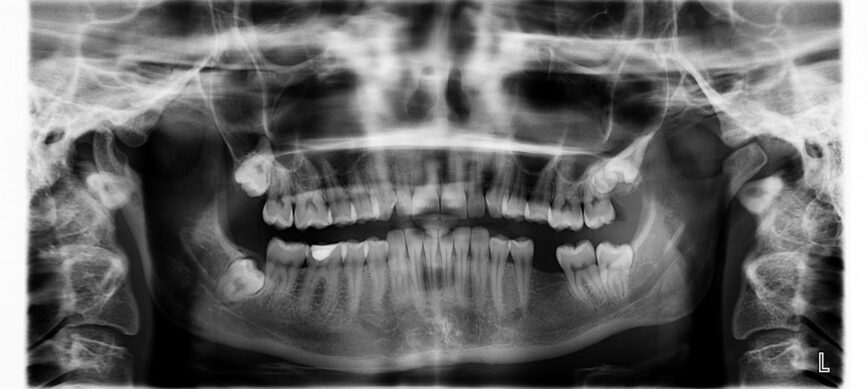 x ray, teeth, tooth is missing, x ray, x ray, x ray, teeth, teeth, teeth, teeth, teeth