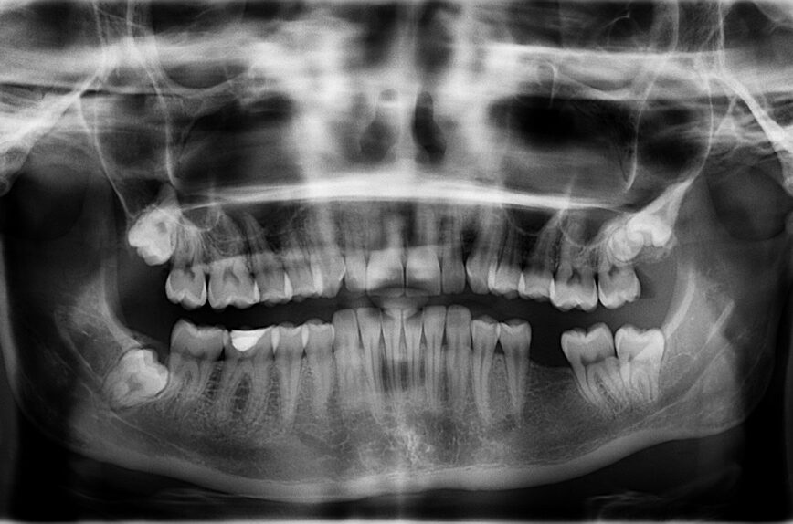 x ray, teeth, tooth is missing, x ray, x ray, x ray, teeth, teeth, teeth, teeth, teeth