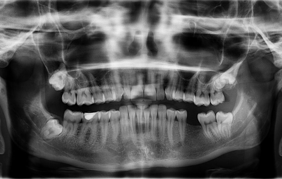 x ray, teeth, tooth is missing, x ray, x ray, x ray, teeth, teeth, teeth, teeth, teeth