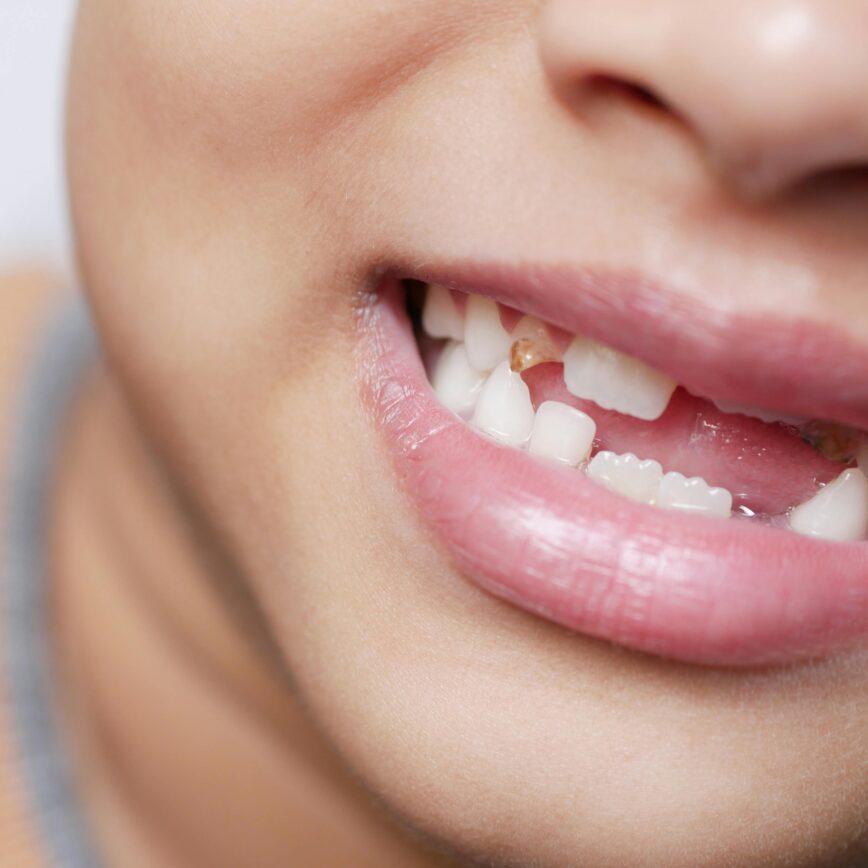 Detailed image showing a child's mouth with missing teeth, capturing a youthful smile.