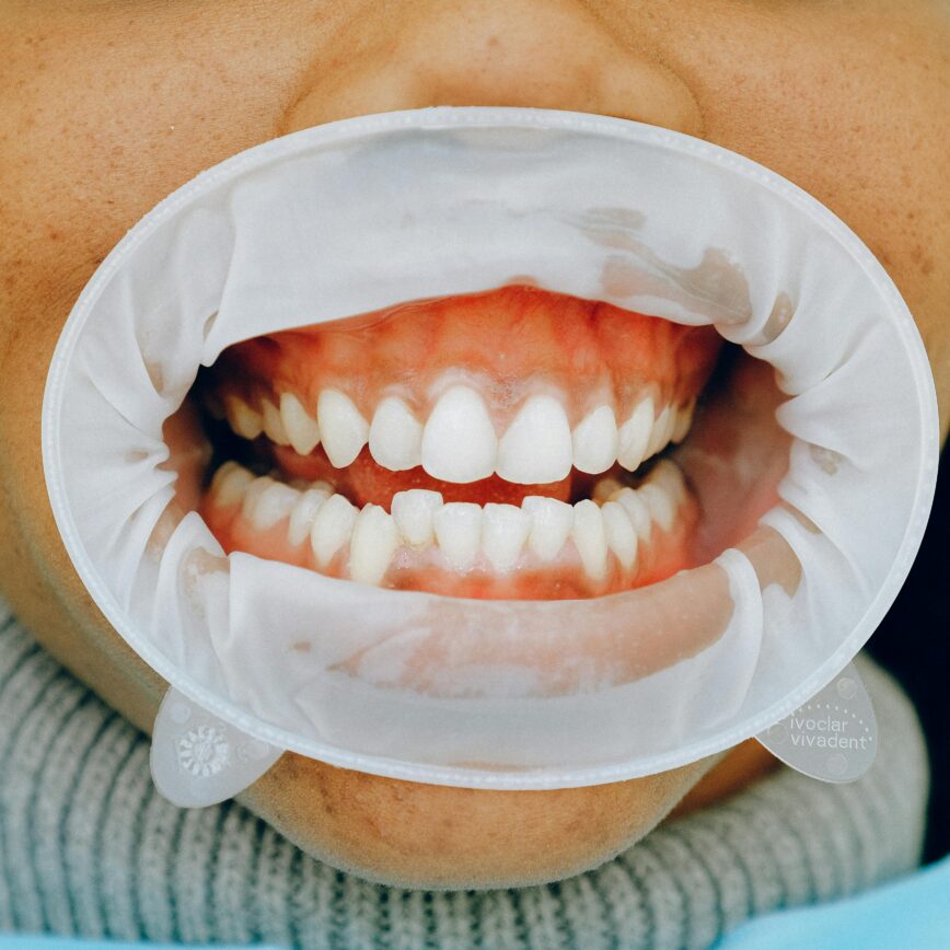 Detailed image of a woman's open mouth during a dental checkup using a cheek retractor.