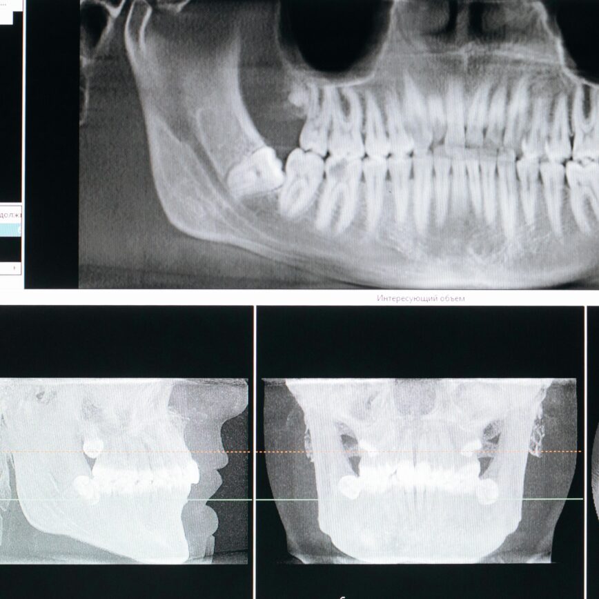 Detail image of a panoramic dental X-ray, showing teeth and jaw structure.