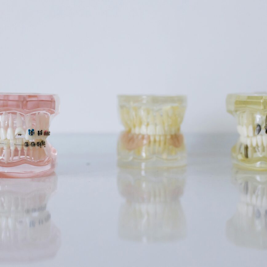 Close-up of dental models displaying braces and dentures for orthodontic education.