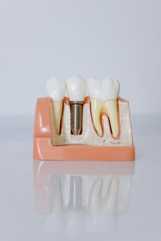 pexels-photo-6502306-6502306 Detailed view of a dental implant model showcasing teeth and gum anatomy for dental education.