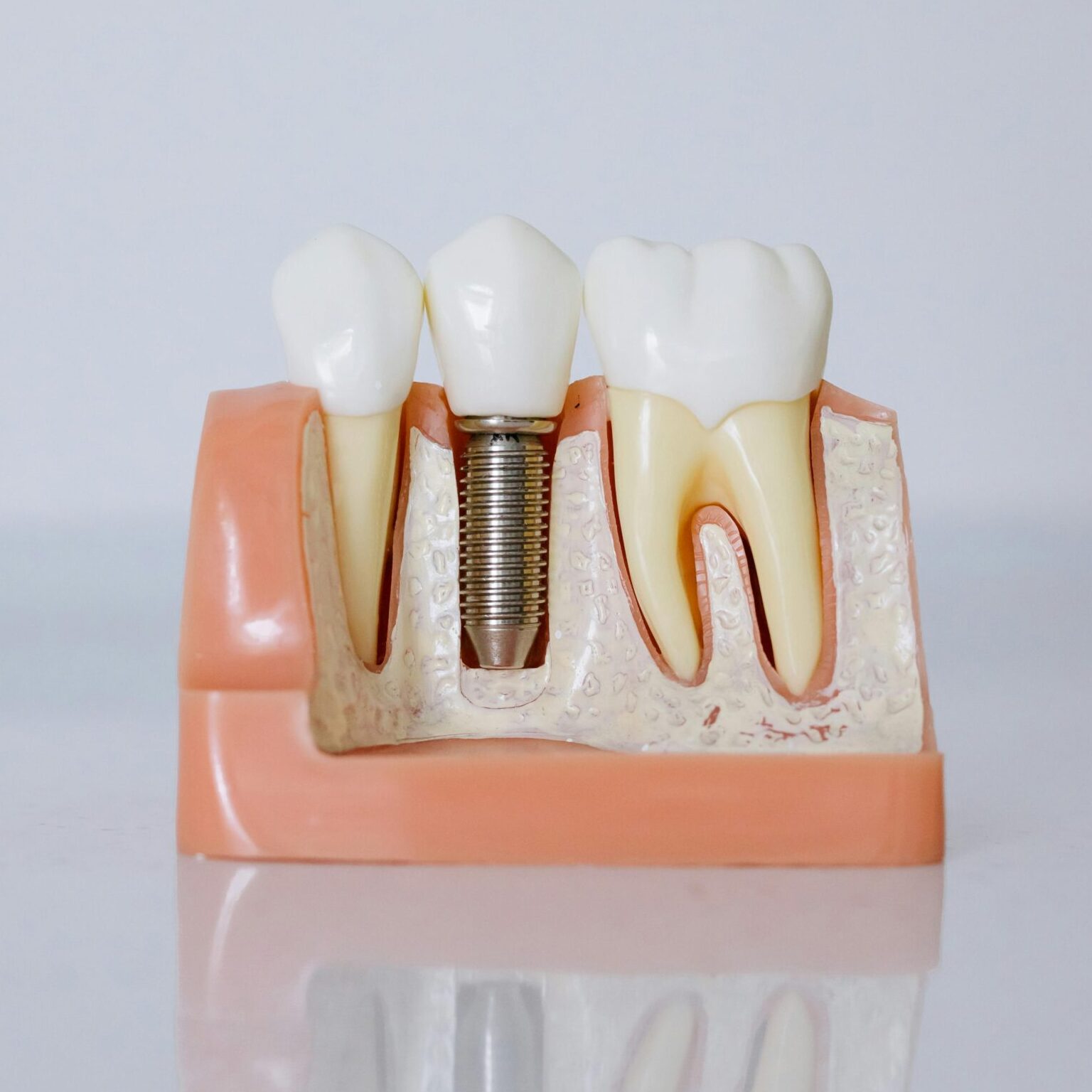 Detailed view of a dental implant model showcasing teeth and gum anatomy for dental education.