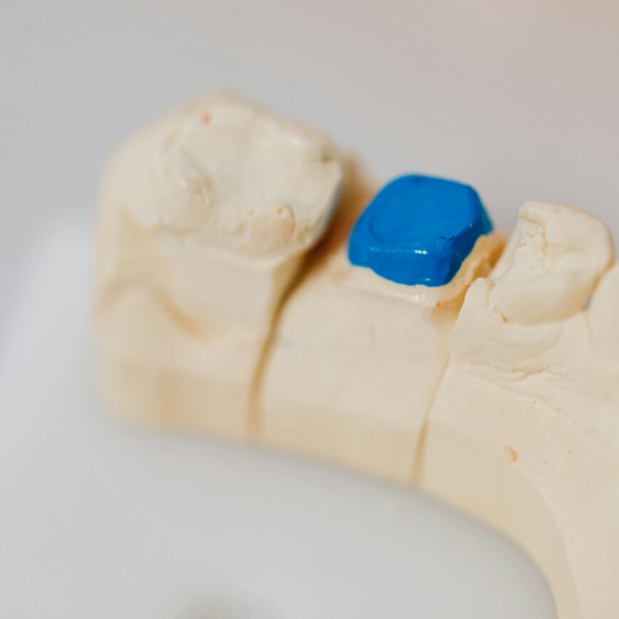 Close-up of a dental jaw model with a blue filling, showcasing dental anatomy and dentistry tools.