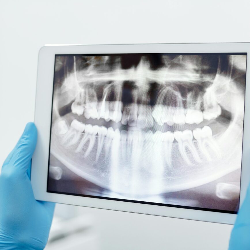 Blue-gloved hands holding a digital tablet displaying a detailed dental X-ray scan.